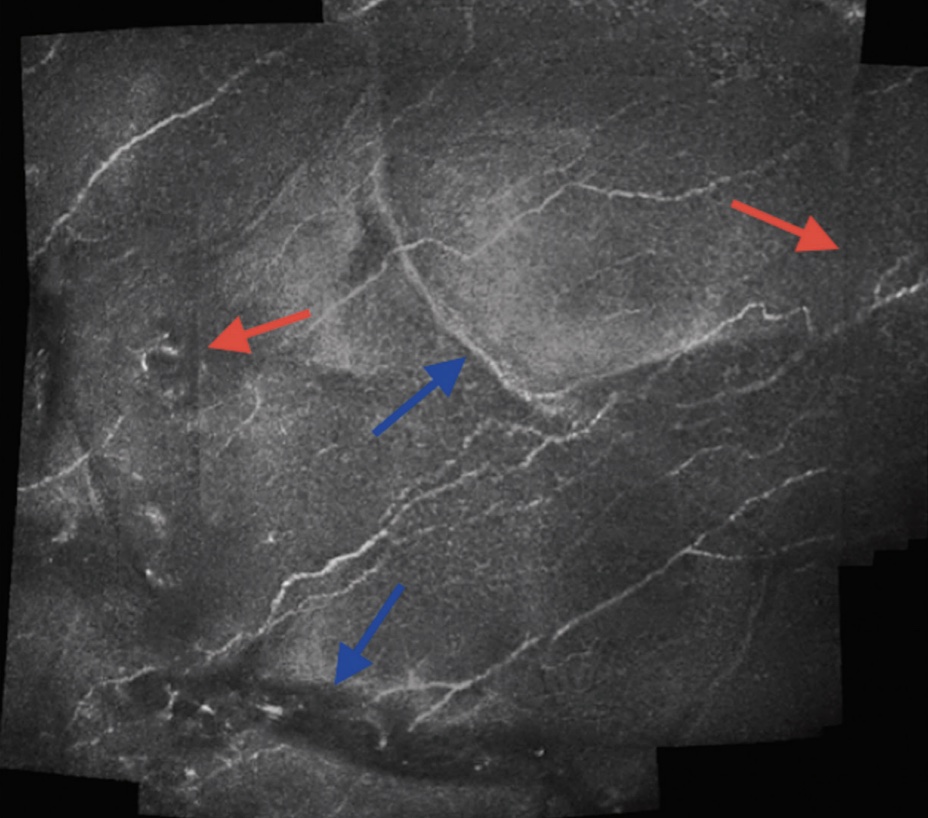 A stitched confocal microscopy mosaic of corneal nerve fibers, with arrows marking seams